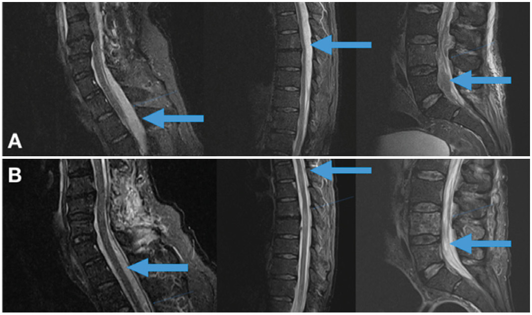 Imagen Cervical Thoracic Lumbosacral MRI