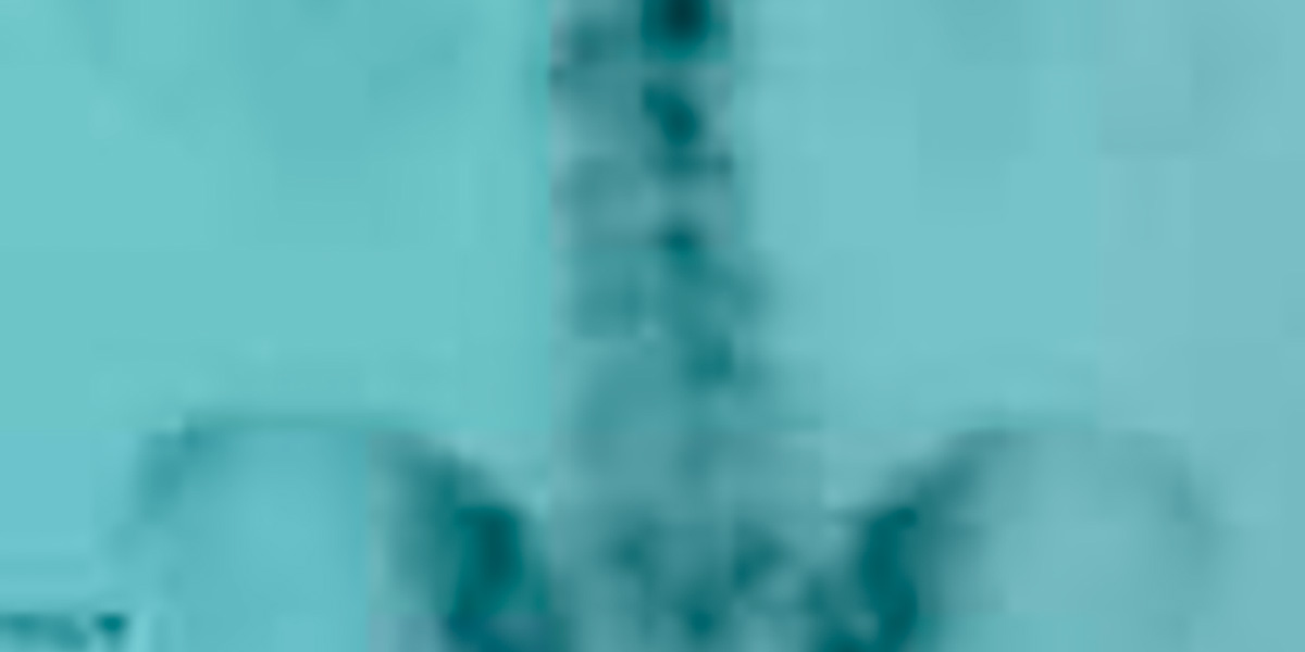 Imagen Osteoma Osteoide